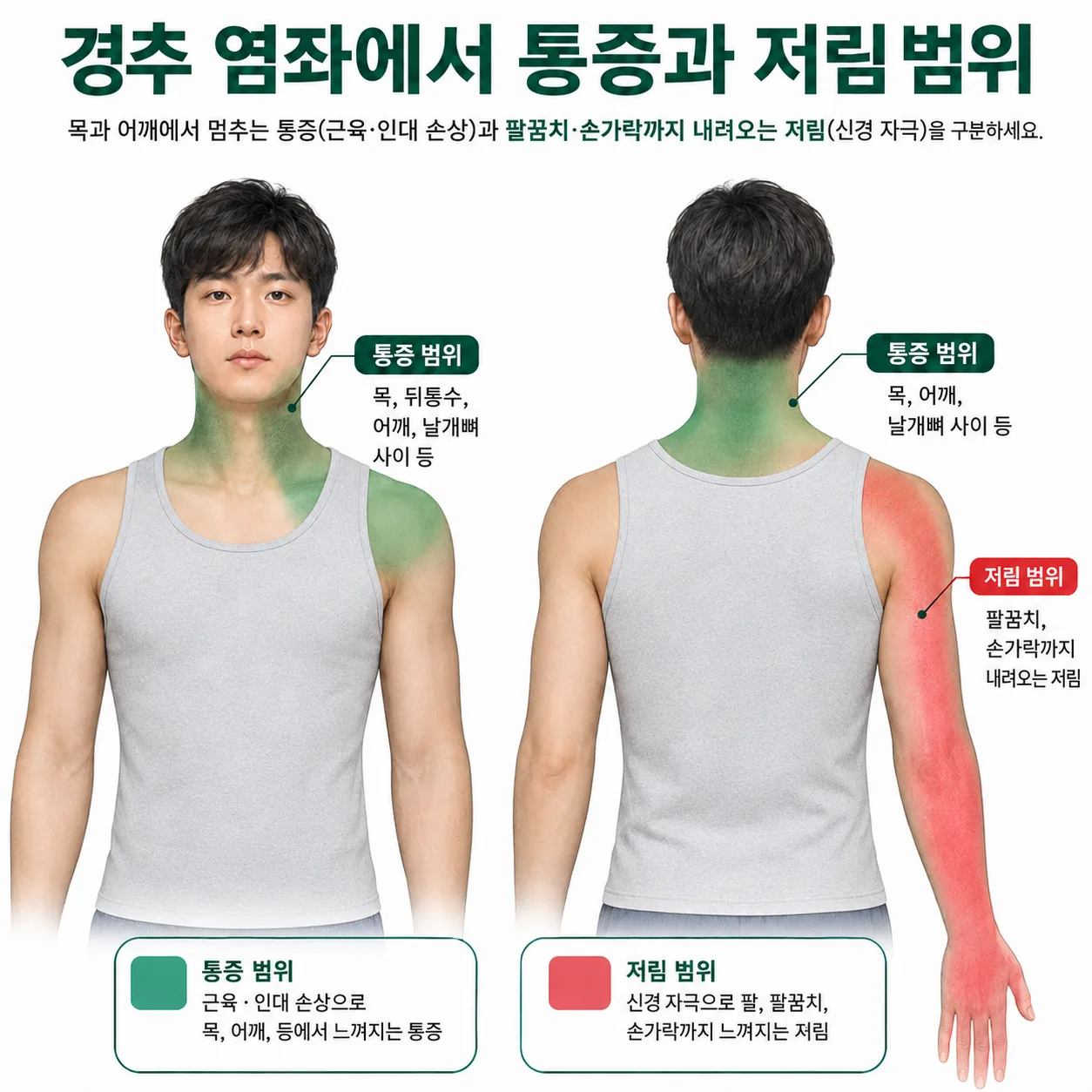 경추 염좌에서 목에 머무는 통증 범위와 팔로 뻗치는 저림 범위를 구분한 그림