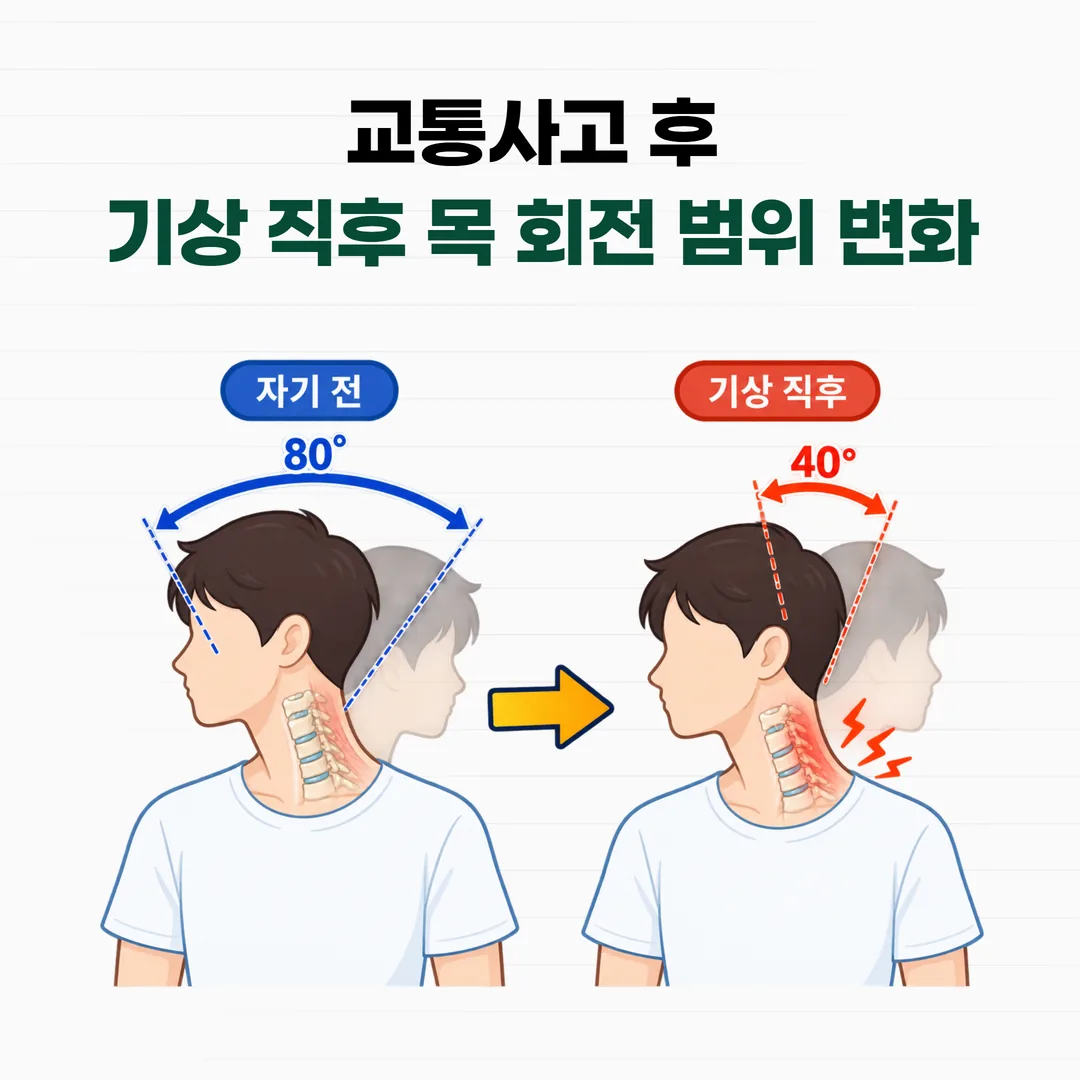 교통사고 후 아침 기상 직후 목이 돌아가는 각도가 줄어든 모습