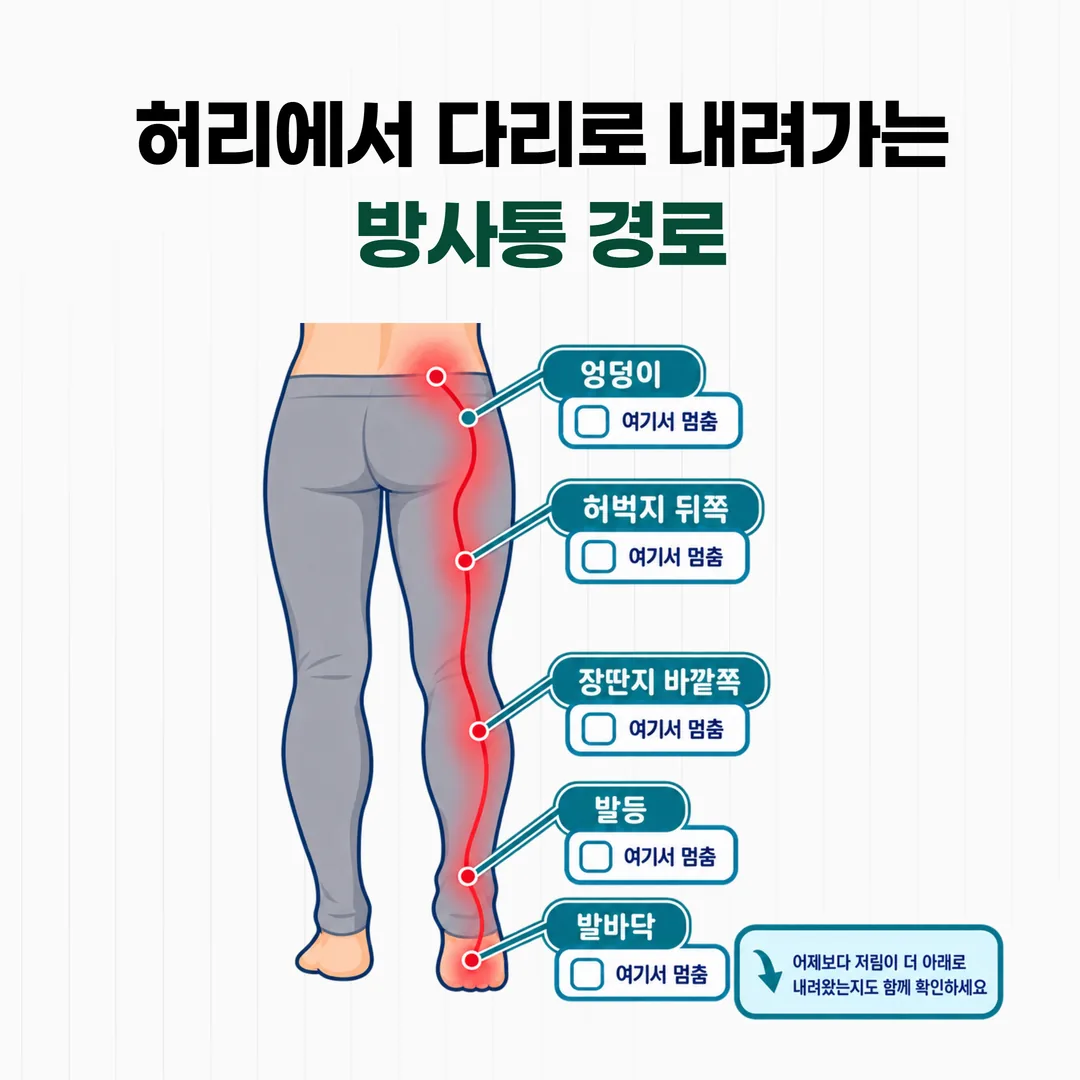 허리에서 다리로 내려가는 방사통 경로 구분 도해