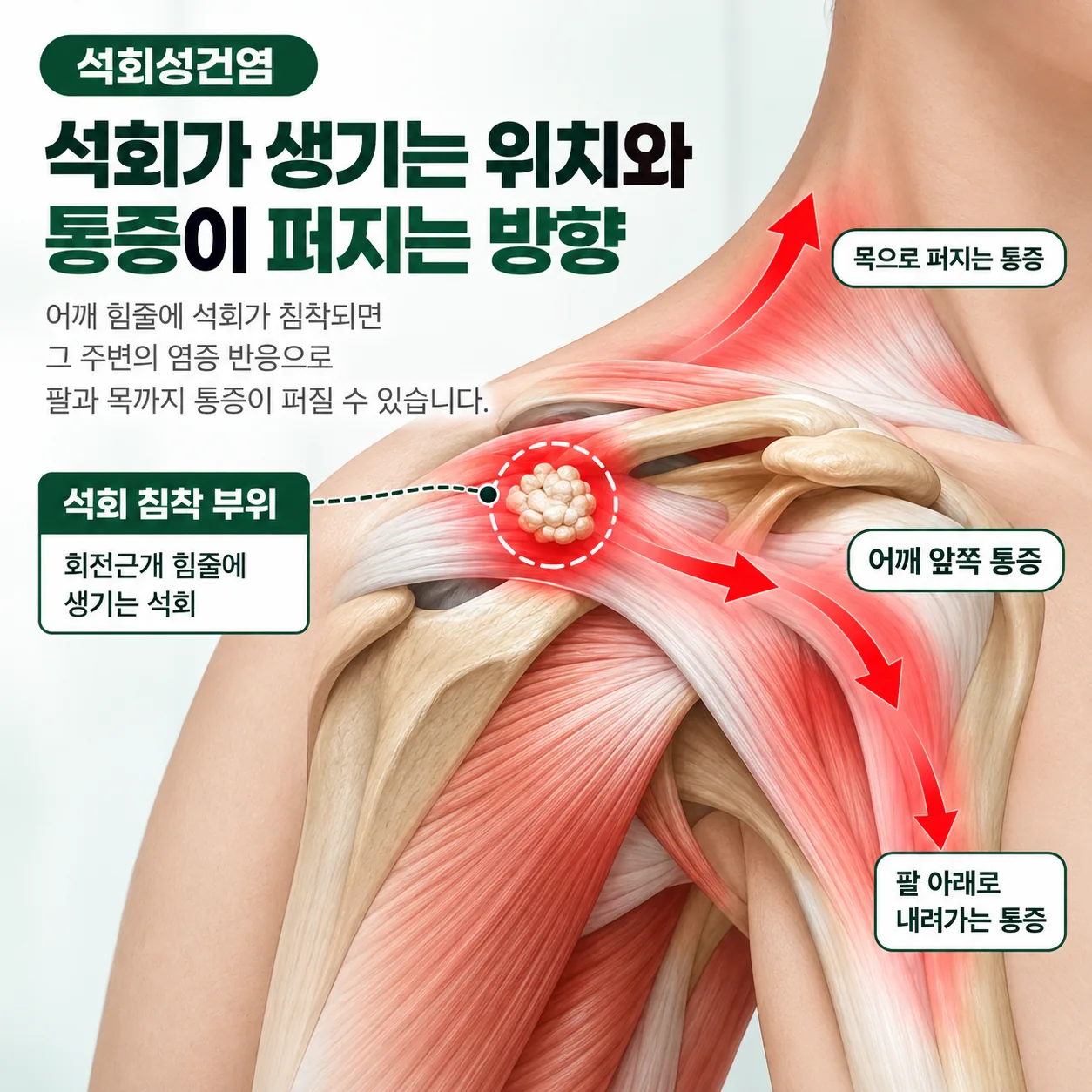 어깨 석회성 건염에서 석회가 침착된 자리와 통증이 퍼지는 방향 개념도
