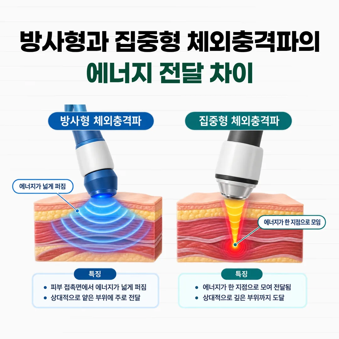 방사형과 집중형 체외충격파의 에너지 전달 범위와 깊이를 비교한 도해