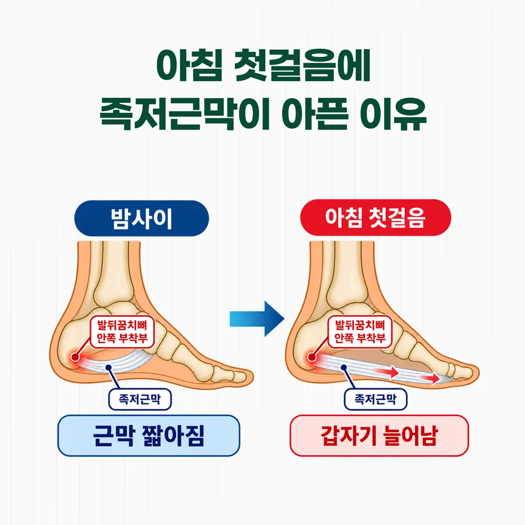 족저근막이 밤사이 짧아졌다가 첫 걸음에 늘어나는 과정을 그린 발 단면 개념도